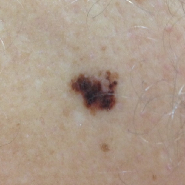 asymmetry of melanoma
